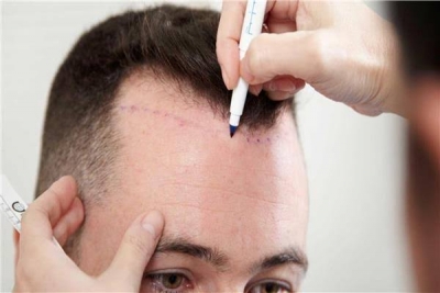 استشاري تجميل يشرح خطوات زراعة الشعر بـ«الاقتطاف»