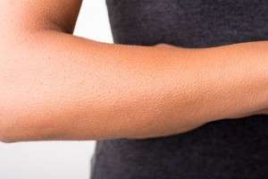 طرق علاج الجلد ذو المسام البارزه